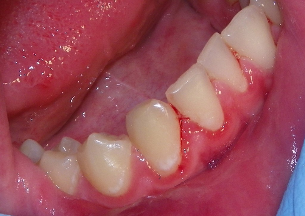 Plaque Induced Gingivitis