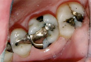 Barrie Dental Restoration Crown Before Dental Restoration Crown Before