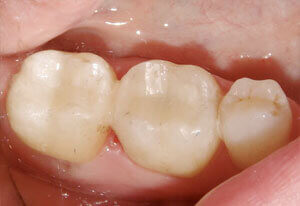 Barrie Dental Restoration Filling Case After Dental Restoration Filling Case After