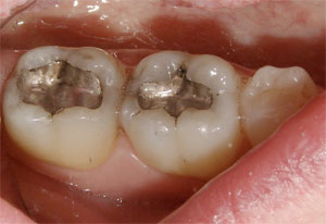 Barrie Dental Restoration Services Dental Restoration Filling Case Before