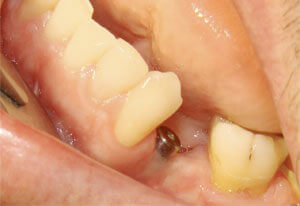 Implant Before