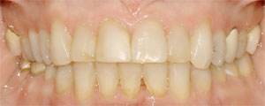 Otho After