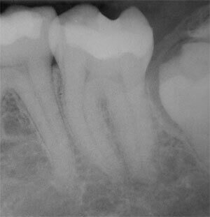 Root Canal Before