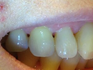 Recession that has progressed to the point that unsightly black spaces appear between the teeth.  These are not only aesthetic problems, they are food traps as well.  In Dr. Wong's case, this is not a typical case of periodontitis as oral hygiene is good.