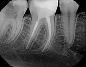 Broken Tooth - Barrie Dentist - Dr. Elston Wong
