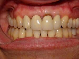 This is the condition of the front teeth that prompted treatment.  The left upper front tooth showed root darkness at the gumline, and there was a crack in the porcelain of the patient's upper right lateral incisor (the one next to the right front tooth)