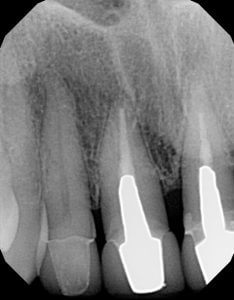 Periapical (PA) x-ray of the upper right front teeth.