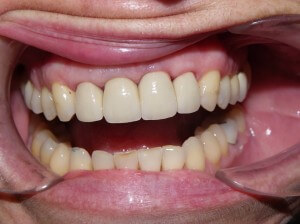 Final Crowns - Barrie Dentist - Dr. Elston Wong