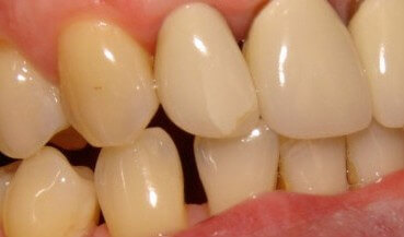 crack in tooth