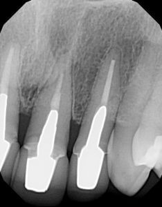 Periapical (PA) x-ray of the upper left teeth.  The obturation of the upper left central incisor was short, and the PDL space was slightly widened.