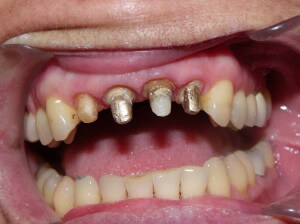 Here is what teeth look like when prepared for crowns.  In this case, the patient was fortunate to have had a fair bit of remaining tooth structure under the old crowns, making it feasible to make new ones.