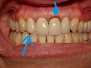 The areas of concern are pointed out. This case is now a cosmetic failure.