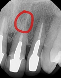 If you had no idea what the above photo caption meant, look at the red circle.  The filling in the root of this tooth should have gone all the way down.  We referred to an endodontist (root canal specialist) to retreat the tooth.  A  new post and core was then made for the tooth.