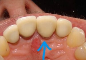 From the underside, we can also see some concerns from an open margin between the tooth and the crown.  Ideally, there should be no gap.  The gap was open enough that we could determine the presence of dental decay setting in under the crown.