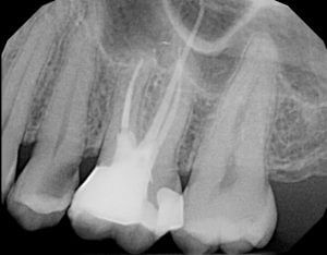 The post-operative root canal x-ray.  The gutta percha filling is easily visible, as is the filling material.  This tooth is still fragile, and should be protected with a restoration that provides cuspal coverage to prevent fracture.  This can be a crown or an onlay.  Our choice here would be an all-ceramic crown (e.max from Ivoclar at the moment).  