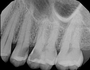 Pre-operative x-ray of tooth 26