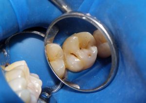 Preoperative appearance of the tooth