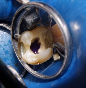 The root canal component is basically complete, and then is followed by the filling.  A traditional Tofflemeier matrix system with G-Rings was used to contain the filling material.  We used air abrasion (PrepStart, Danville engineering (27um, 40psi) to create a clean surface, then acid etched with phosphoric acid.  Bonding was done via OptiBond FL (Kerr) primer and adhesive.  The purple seen here is intended to seal off the canals to prevent reinfection, and at the same time make it easier to locate the canals on any subsequent re-entry (PermaFlo Purple, Ultradent). 