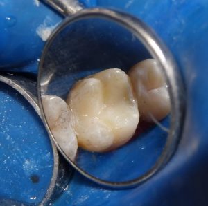 The completed dental restoration.  We used Kerr's EsthetX direct composite resin.  This tooth should now be protected with a full-coverage indirect restoration (onlay or crown) that provides cuspal coverage, or else the tooth will remain vulnerable to fracture.