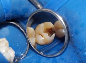 Appearance of tooth after being entered, with a lot of decay inside