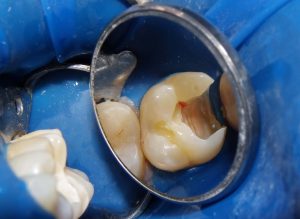 Appearance of tooth after decay has been removed