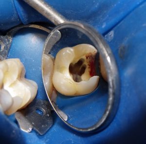 Further decay removal from the tooth.