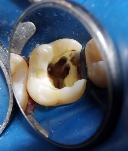 Tooth prepared with K3 nickel-titanium files