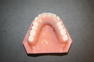 A bar-supported implant removable complete denture. This type of denture does not cover the palate, and looks like a regular complete denture except for horizontal pins that lock in the denture. These pins are unnoticeable from the outside, and lie flush with the acrylic of the denture (the model shown has the pins sticking out slightly for illustration)