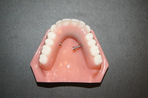 A bar-supported removable implant denture with a locking pin sliding out. These pins cannot be completely removed; they slide out only enough to unlock the denture from the underlying bar (see next photo).