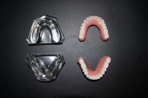 Upper and lower removable complete dentures that attach to implants. The models show four implants for the upper arch and two for the lower arch.