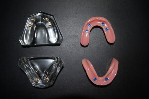 The underside of implant-assisted removable upper and lower complete dentures. The blue housings attach overtop the implants in the mouth, providing a secure snap fit.