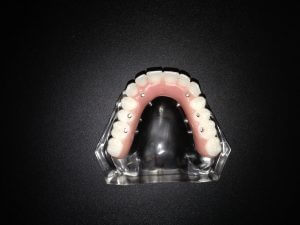 This image shows the biting surface of a non-removable arch of teeth supported by six implants. The screw access holes are visible for illustrative purposes, but are filled in after the bridge is screwed down onto the implants. The prosthesis is removable only by your dentist.