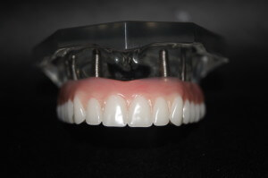 A non-removable implant-supported arch of teeth supported by six implants. A titanium bar forms the substructure of the bridge, which is then screwed down onto the implants.