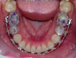 Lower arch orthodontic treatment in progress