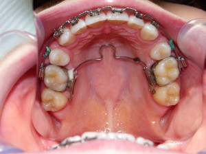 Upper arch orthodontic treatment in progress