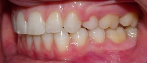 Left view of the teeth after orthodontic treatment.