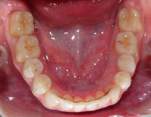 View of the lower arch after treatment with a lower retainer bonded