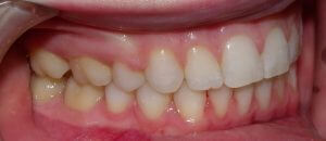 Post-orthodontic view of the right side teeth with cheek retractors in place.