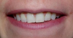 View of the patient's smile after orthodontic treatment