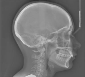 Pre-treatment lateral cephalometric radiograph