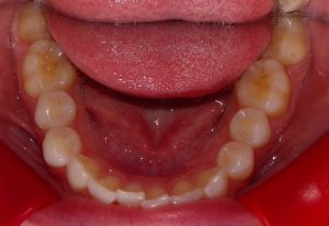 Pre-orthodontic view of the lower arch of teeth.