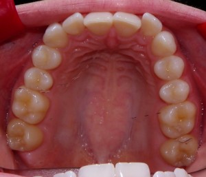 Pre-orthodontic view of the upper arch. 