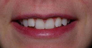 Front view of the patient's smile prior to orthodontics