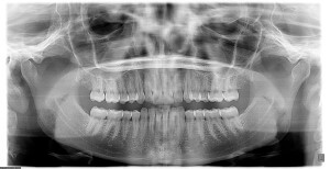 Pre-orthodontic panoramic radiograph with wisdom teeth removed.