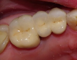 A final PFM (porcelain-fused-to-metal) bridge is cemented onto the supporting, or "abutment" teeth.  We used Glass Ionomer cement in this case (3M RelyX Luting).