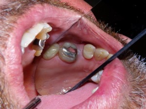 A mirror shot of the upper arch showing a missing tooth.  The space is smaller than the original missing tooth due to drifting of teeth since the loss of the tooth.