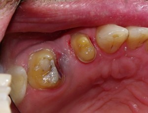 The teeth adjacent to the space were reduced in size and made parallel to each other in order to create a single path of insertion, or "draw".  This works out to about 1.5mm off the top and 1mm circumferentially.