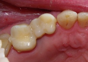 A temporary bridge is made to fit over top of the supporting teeth while the final bridge is made in a dental laboratory.