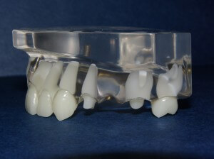 This photo shows a model of an arch with a missing tooth.  The teeth on either side of the space have been reduced, or "prepared" for a bridge by being made smaller in size.  This creates room for the incoming bridge and avoids a bridge that is larger than the original teeth.