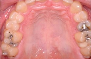 A mouth with seemingly normal-appearing tissues